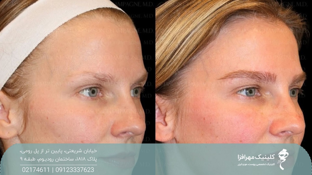 بهترین سن کاشت ابرو