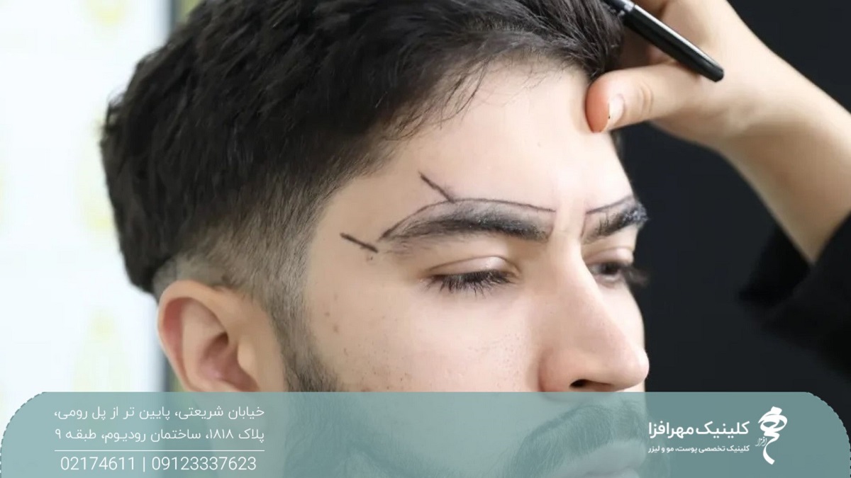 بهترین سن کاشت ابرو