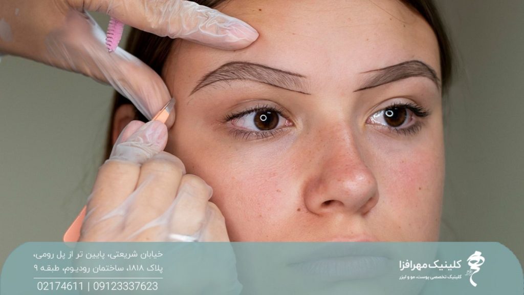 بهترین سن کاشت ابرو