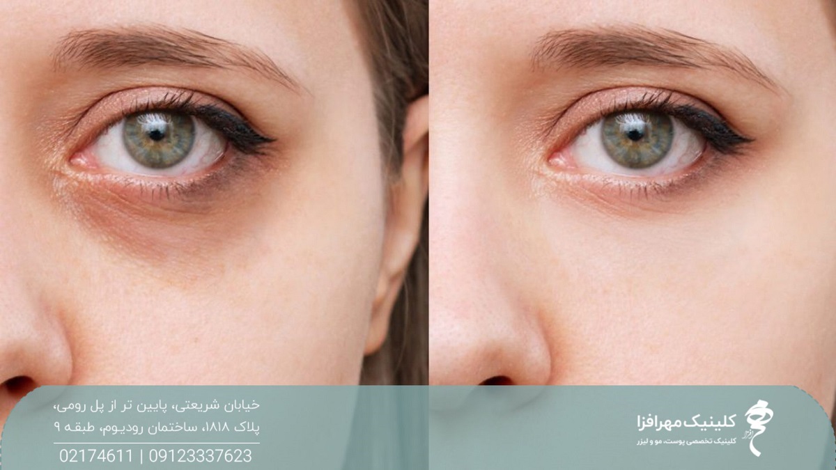 عکس قبل و بعد تزریق مزوژل به صورت دختر جوان که تیرگی و گودی زیر چشم دختر را برطرف کرده است