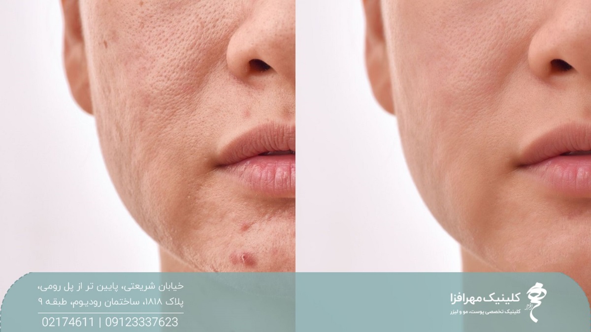 عکس قبل و بعد مزوژل که منافذ باز و آکنه صورت زن را رفع کرده است