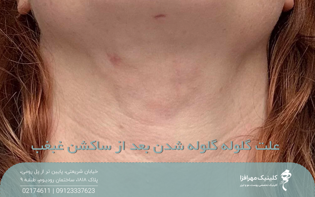 عکس گردن دختری که دچار تورم و قرمزی شده است و روی عکس نوشته شده علت گلوله گلوله شدن بعد از سکشن غبغب