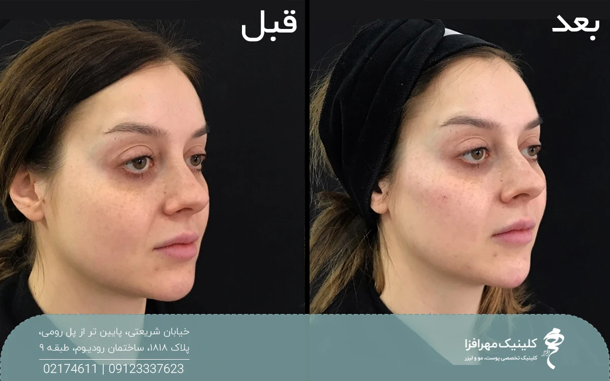 عکس قبل و بعد تزریق ژل گونه برای دختر جوان که باعث زاویه سازی و افزایش حجم صورت او شده است