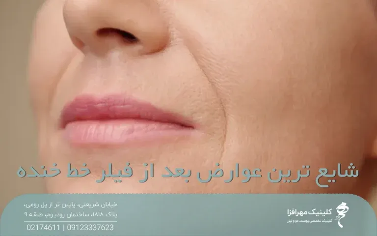 عکس صورت فردی که خط لبخند عمیقی دارد و روی عکس نوشته شده شایع ترین عوارض بعد از فیلر خط خنده