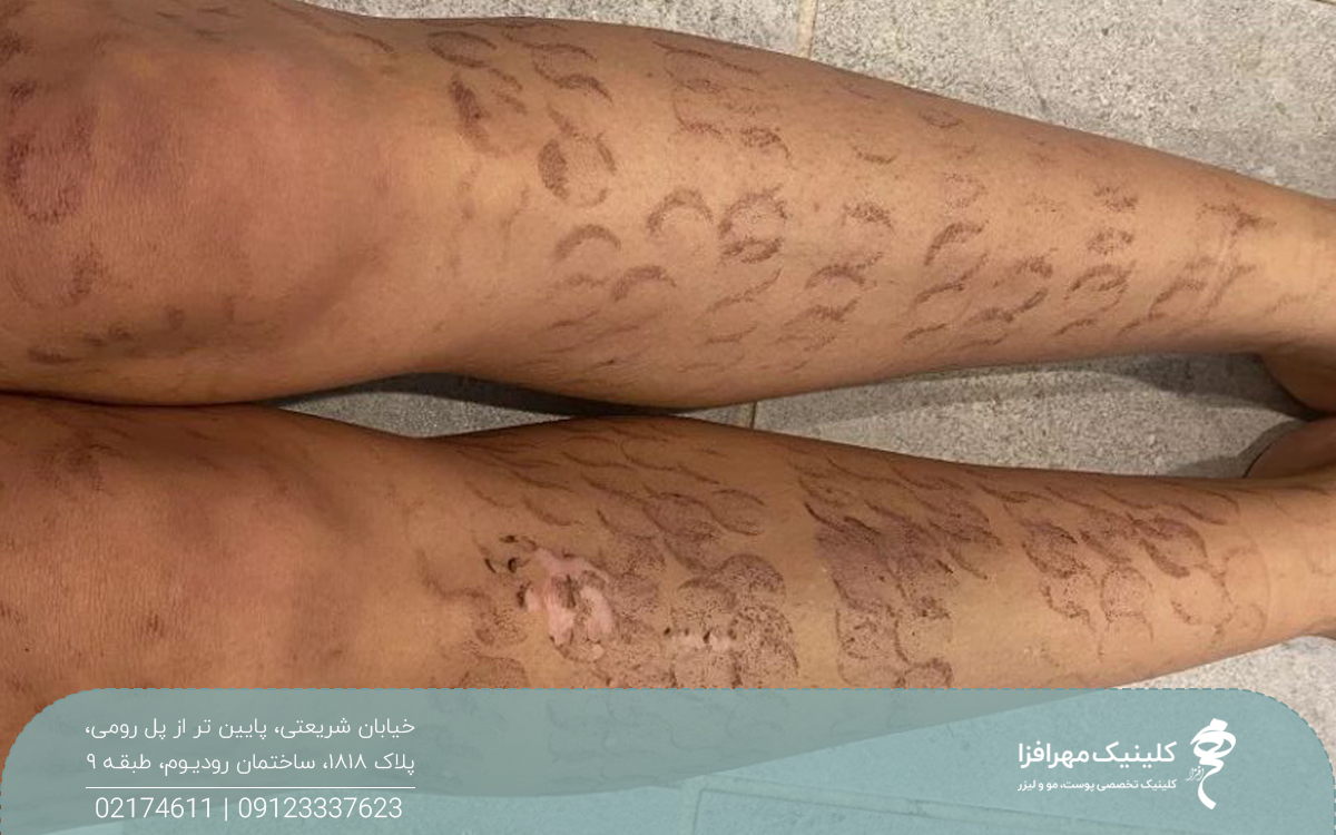 پاهای دختر که بعد از لیزر دچار تغییر رنگ شده و لکه های تیره در نقاطی که لیزر به پوست تابیده ایجاد شده است