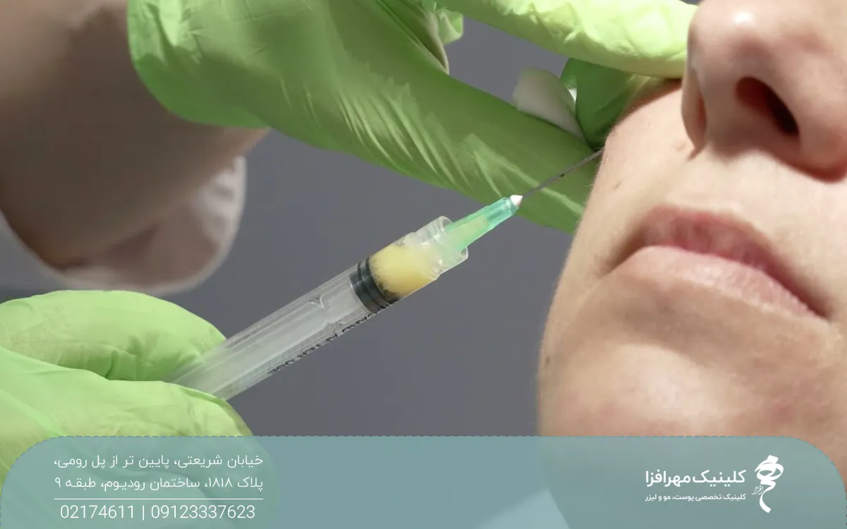 دستان دکتری که در حال تزریق چربی روی صورت فرد است