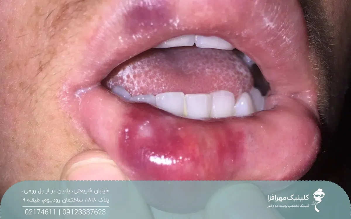 فردی که لب هایش کبودشده است