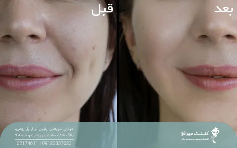 عکس قبل و بعد تزریق فیلر خط خنده روی صورت دختر