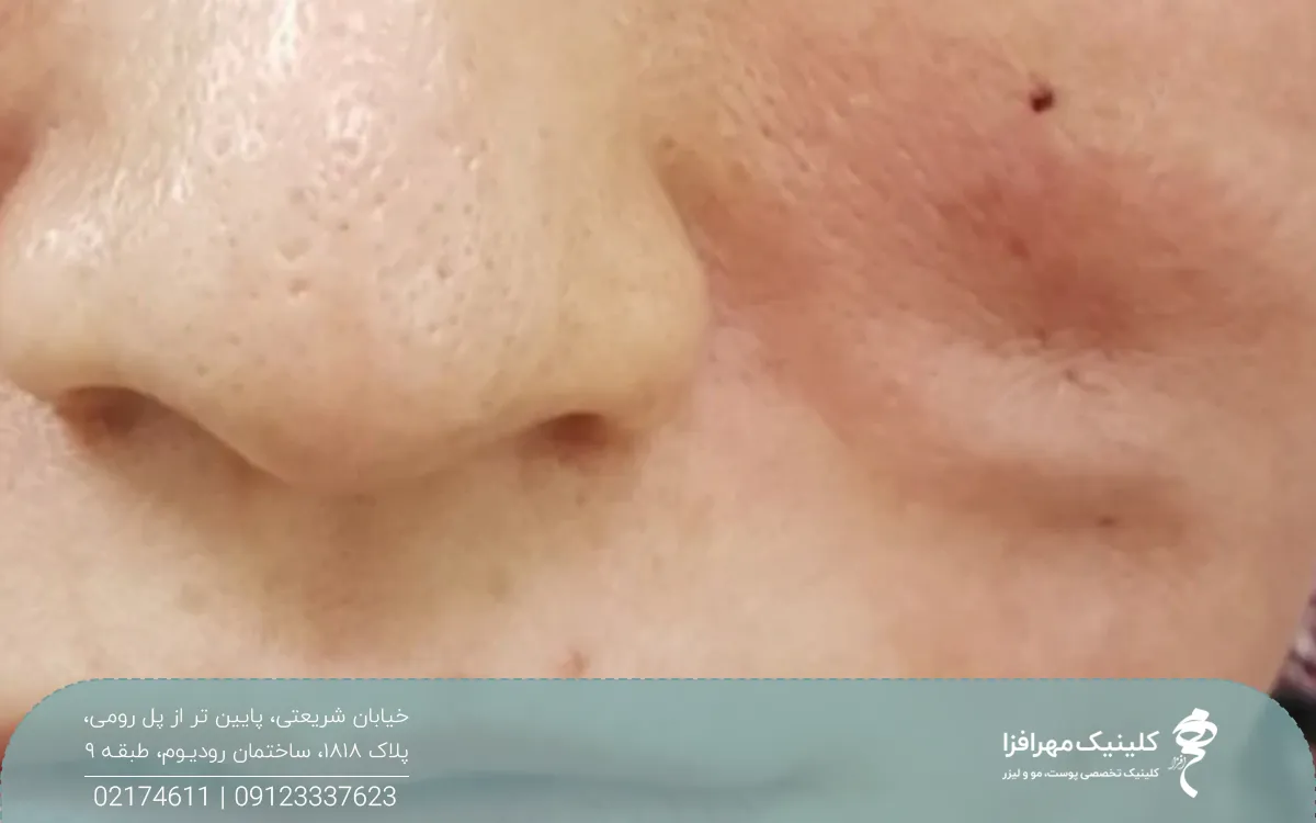 فردی که لیفت و صورت با نخ انجام داده است و نخ پاره شده است و حالا صورت او نامتقارن شده است