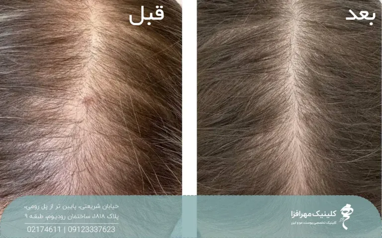 عکس قبل و بعد فردی که مزوتراپی مو انجام داده است و موهای او در ناحیه فرق سر پرپشت شده است