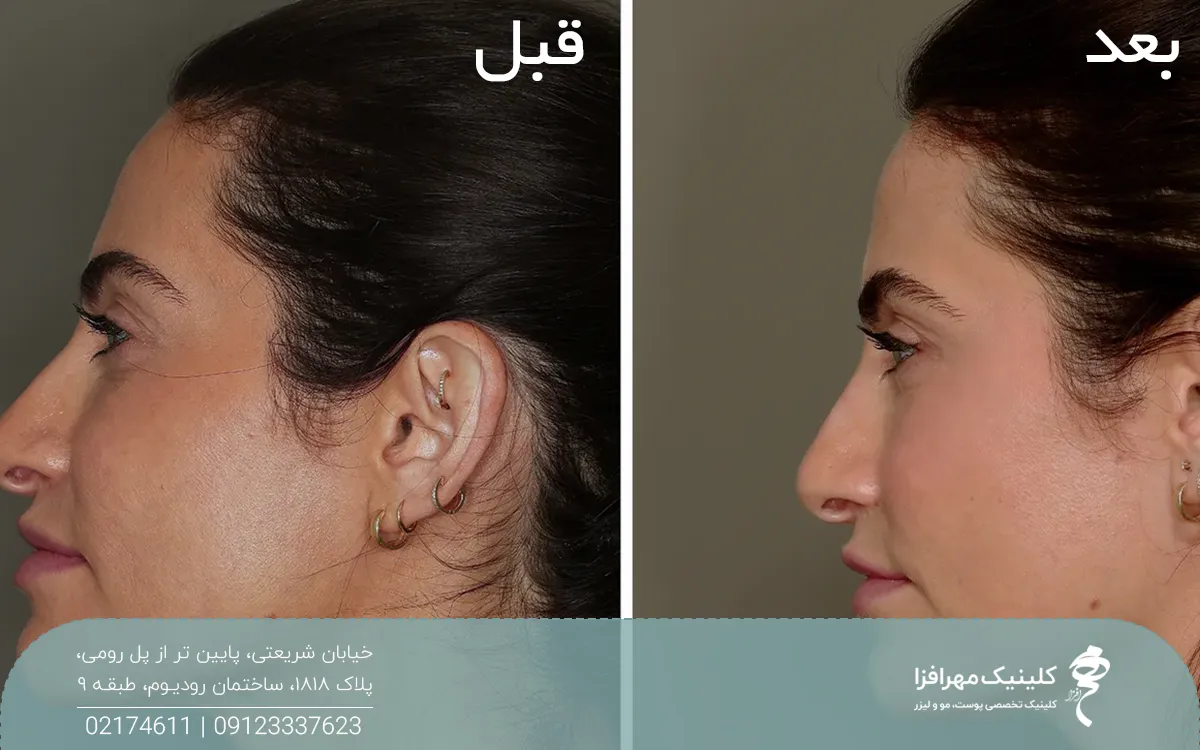 عکس قبل و بعد از تزریق چربی به صورت دختر