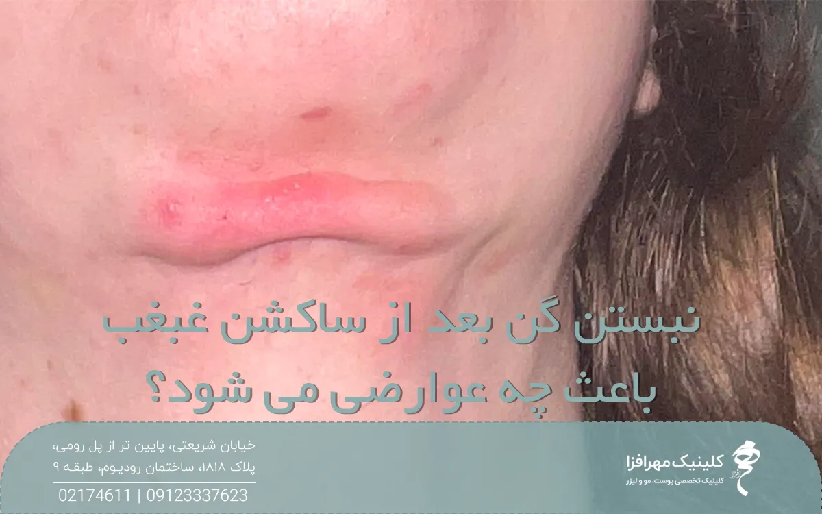فردی که بعد از ساکشن غبغب گن نبسته است و دچار عارضه شده است