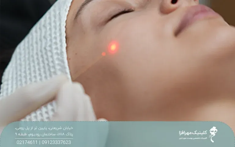 دست پزشک که میکروفیبر اندولیفت را نزدیک صورت دختر گرفته و نور لیزر روی گونه دختر افتاده است