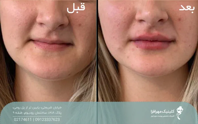 عکس قبل و بعد فردی که تزریق ژل لب عروسکی انجام داده است