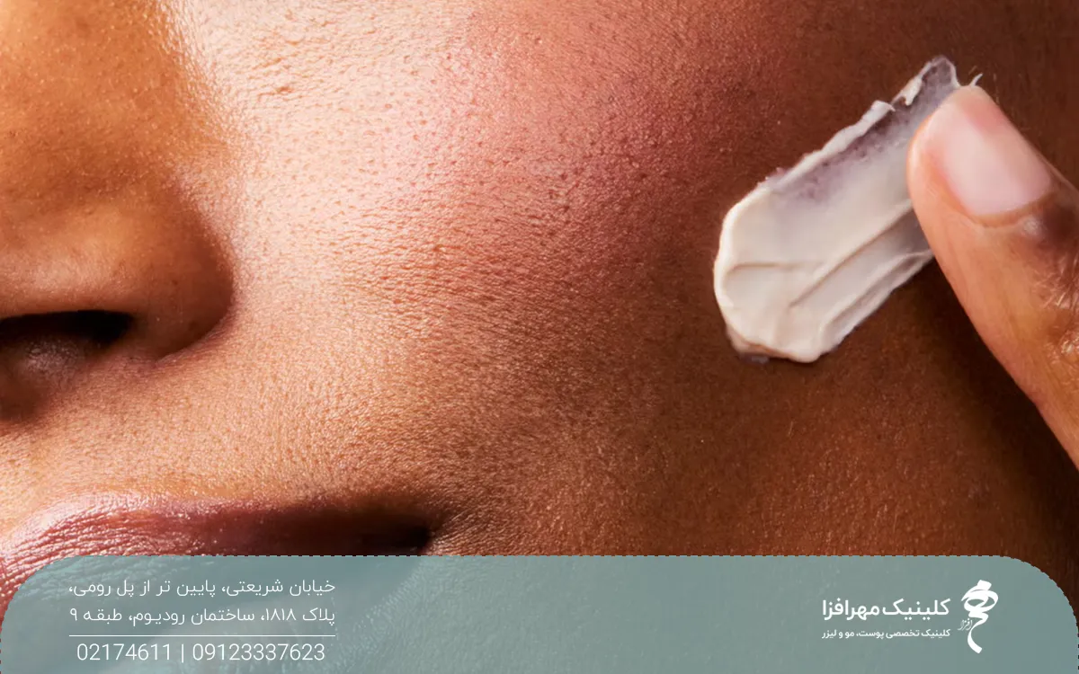 عکس نزدیک از پوست صورت دختری که روی پوست صورت خود کرم مالیده است