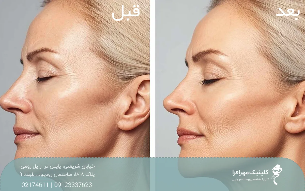عکس قبل و بعد فردی که تزریق پروفایلو انجام داده است
