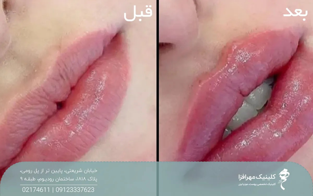 قبل و بعد فردی که تزریق ژل انجام داده است