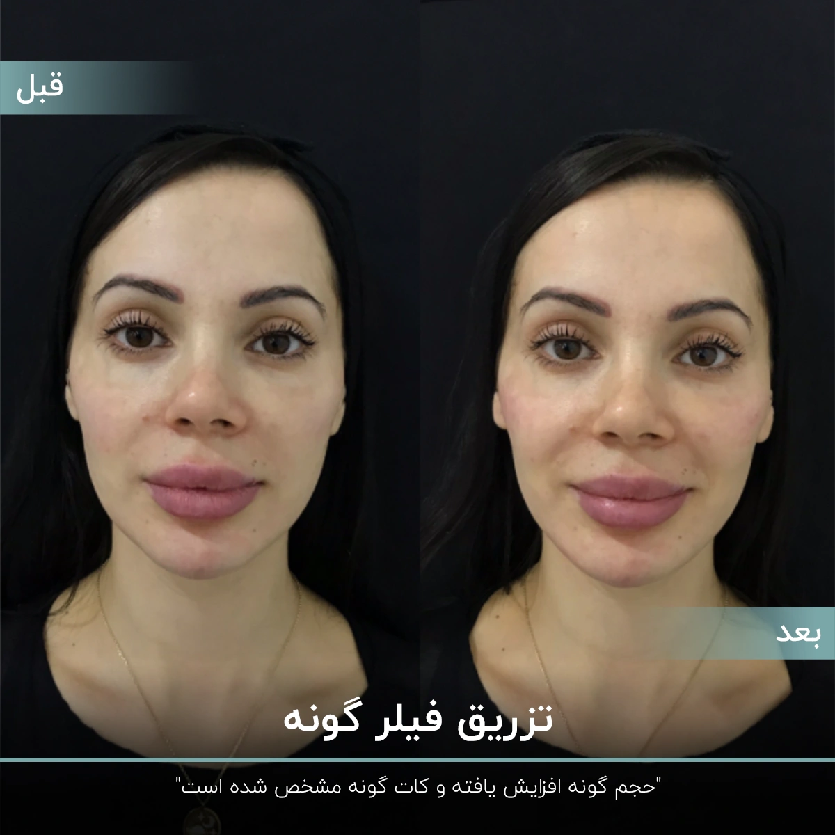 عکس قبل و بعد تزریق ژل گونه به صورت دختر که به صورت تمام رخ نشان داده است که حجم گونه او افزایش پیدا کرده است