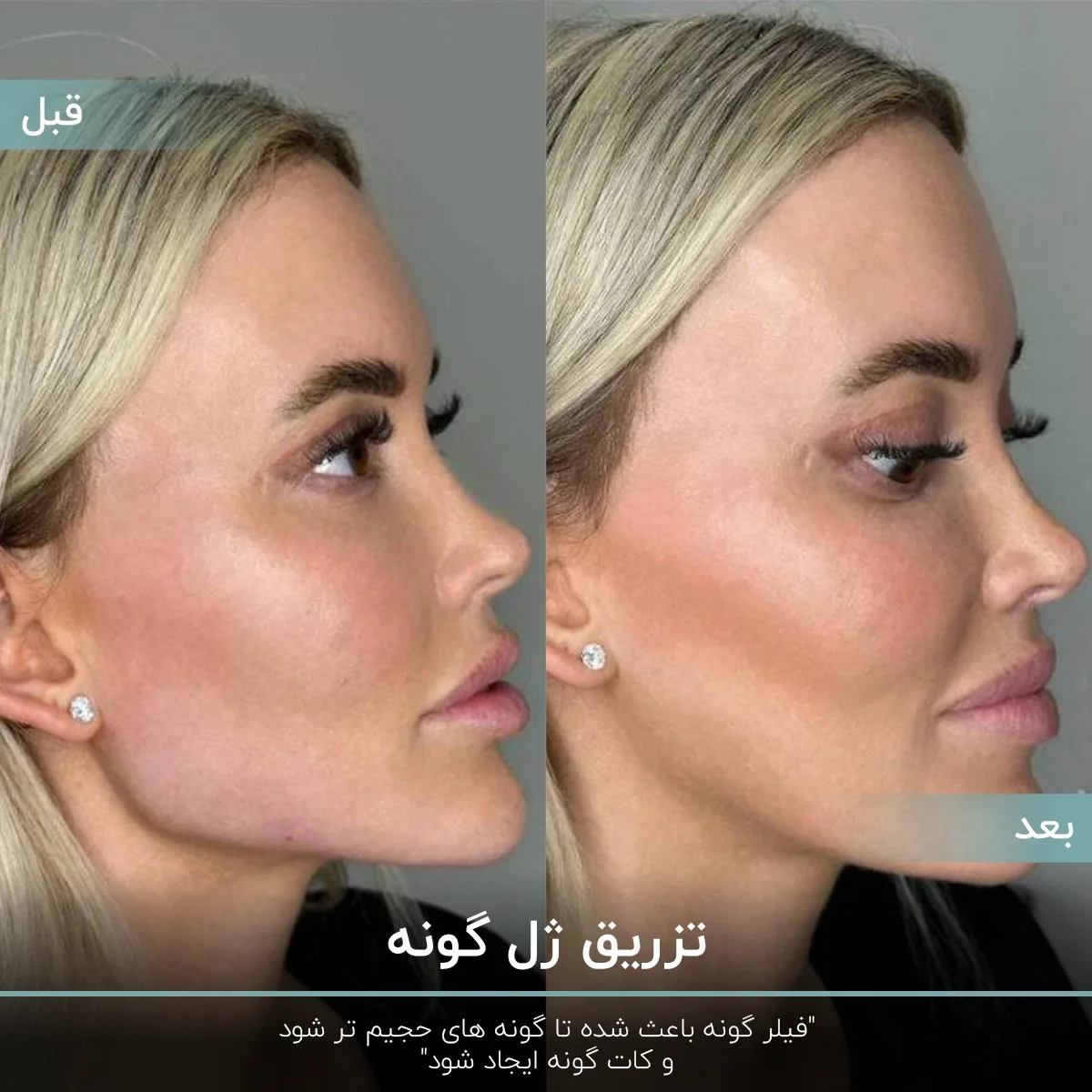 عکس قبل و بعد تزریق فیلر به گونه زن با موی بلوند که گونه های او حجیم شده و کات گونه ایجاد شده