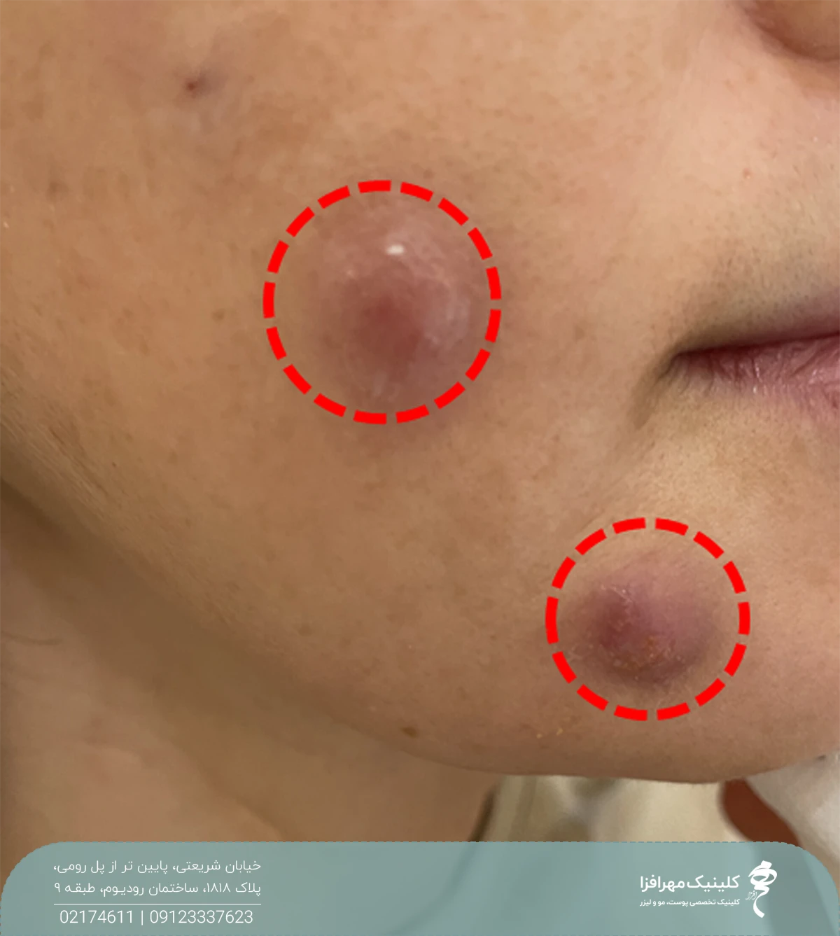 صورت دختری که در اثر پارگی نخ لیفت صورت دچار تورم و کبودی شده است