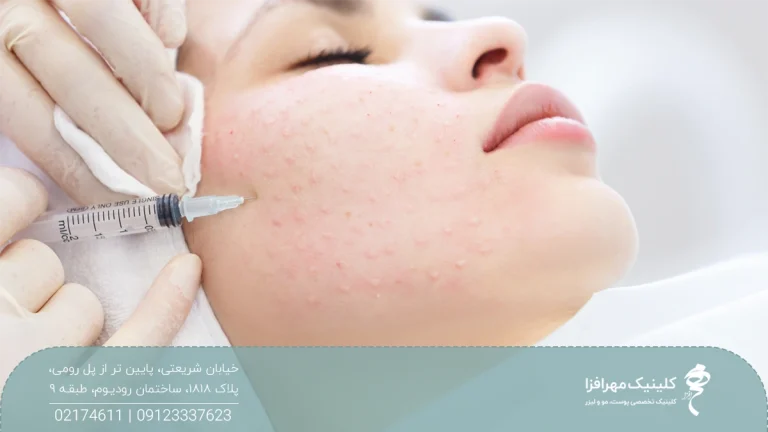 صورت دختری که چشم خود را بسته و به نقاط متعددی از صورت او تزریق انجام شده