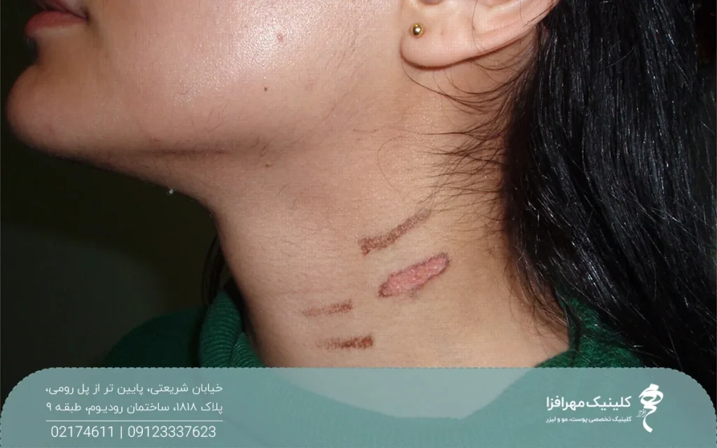 دختری که در ناحیه گردن لیزر موهای زائد انجام داده و حالا گردن او زخم شده است