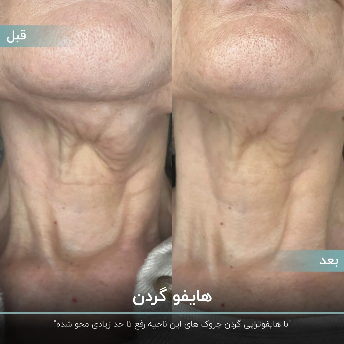 عکس قبل و بعد هایفوتراپی گردن زن مسن