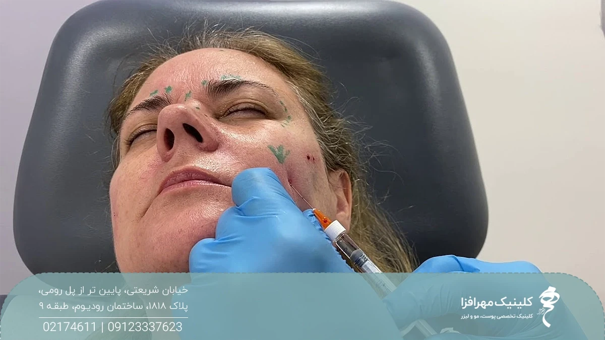 زن میانسالی که چشم خود را بسته و پزشک به گونه چپ او فیلر تزریق می کند