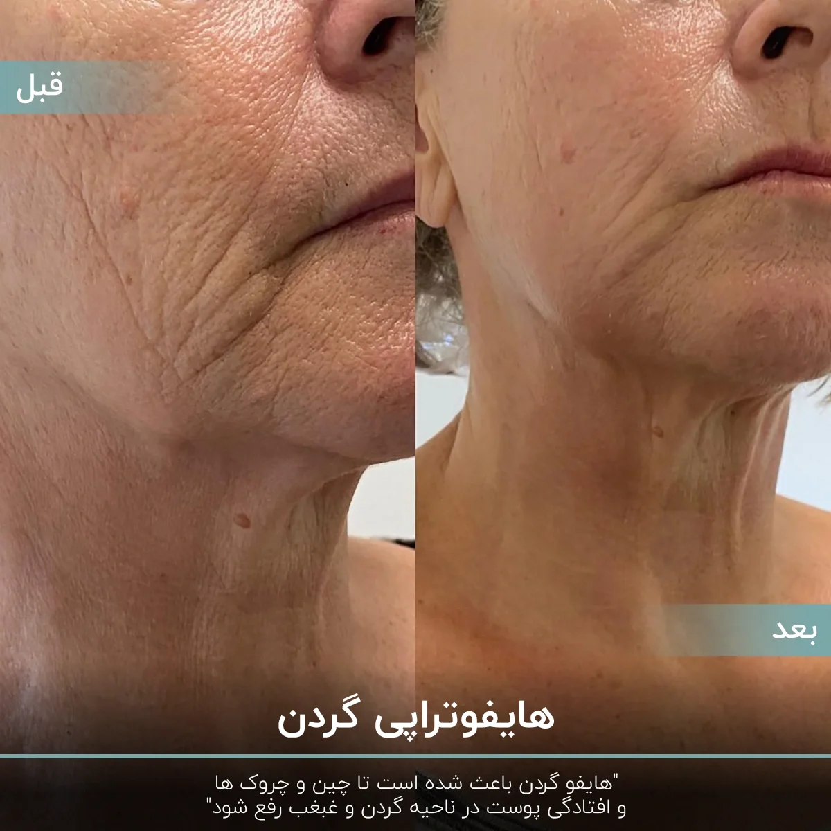 عکس قبل و بعد هایفو گردن زن میانسال که چین و چروک گردن او از بین رفته