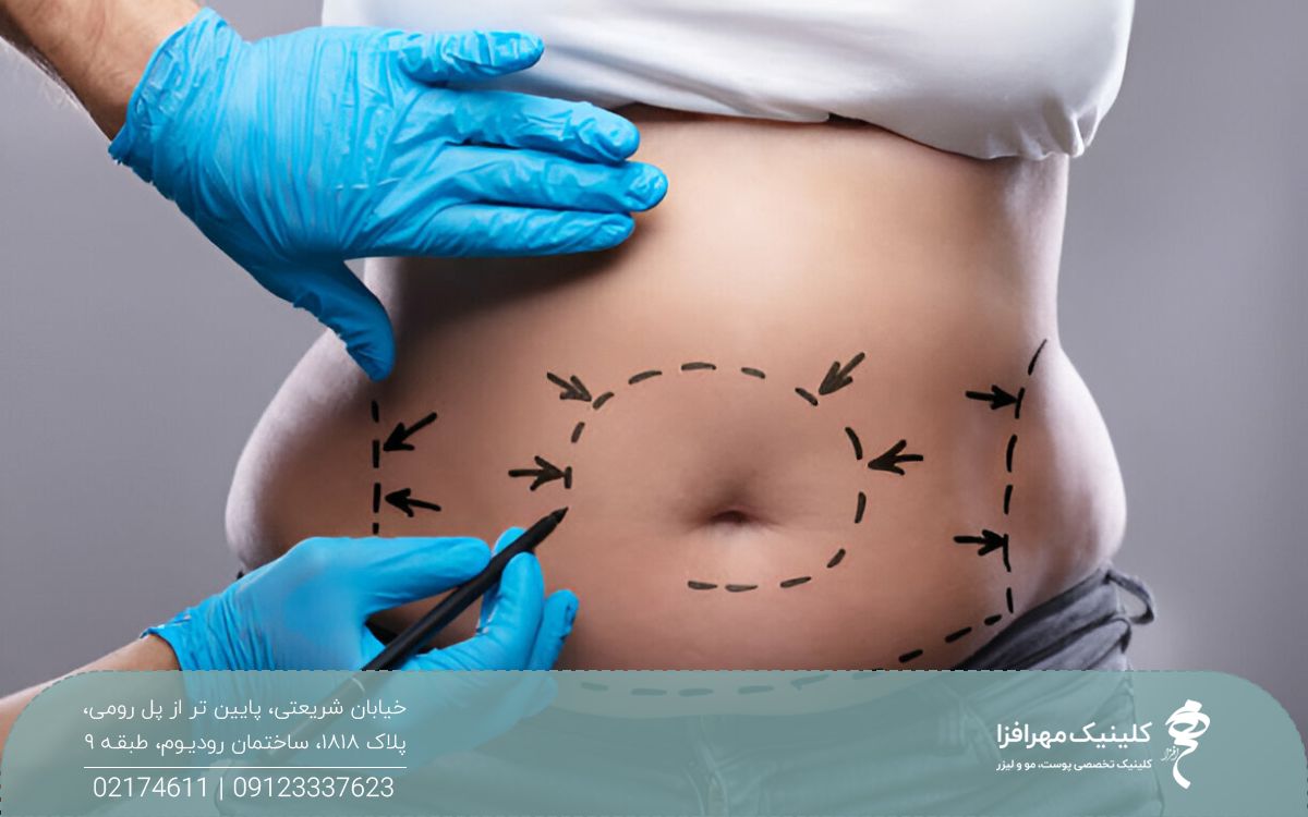 دختری که روی شکمش با ماژیک مشکی چند خط چین و فلش رسم شده است