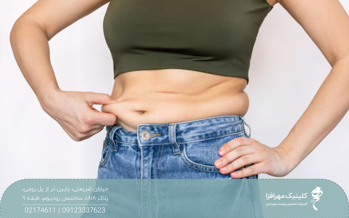 دختری که چربی اضافه شکمکش را با انگشت نگه داشته است