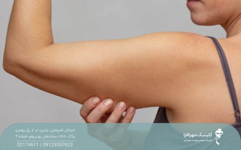 دختری که بازوی او کمی افتادگی دارد و پوست و چربی آویزان را در دست گرفته است