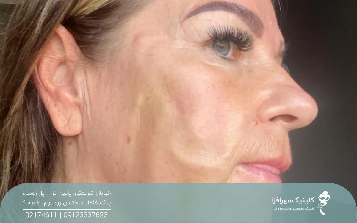 زنی که بوتاکس تزریق کرده و پوست صورت او دچار افتادگی و فرورفتگی شده است
