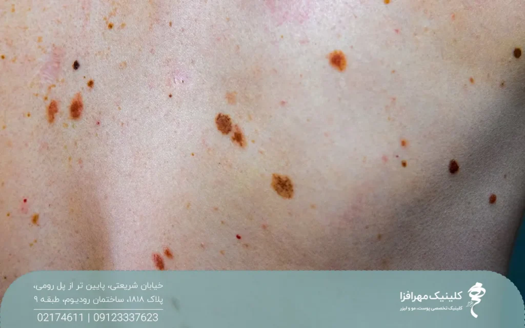 فردی که روی پوستش لکه های قهوه ای دارد که به صورت پراکنده است