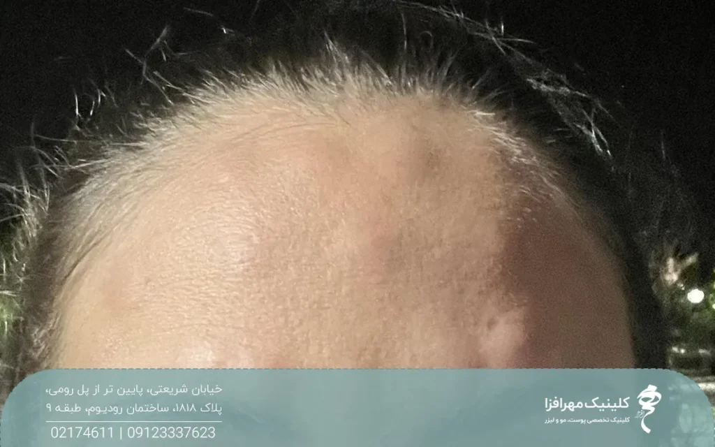 پیشانی دختری که بعد از بوتاکس ورم کرده و به صورت گلوله گلوله شده است