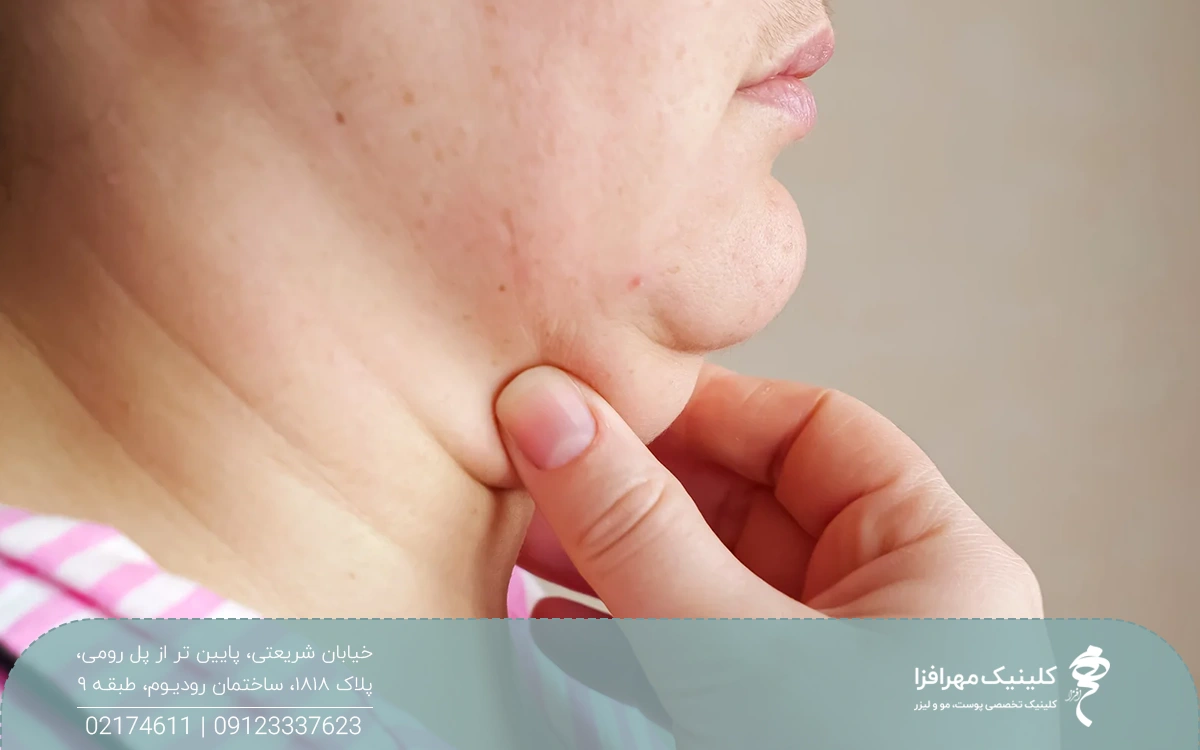 عکس از گردن و غبغب فردی که در ناحیه غبغب چربی زیادی دارد و چربی این ناحیه را با دست گرفته است