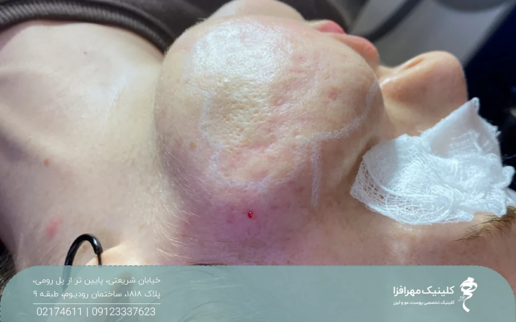 دختری که سابسیژن انجام داده و صورتش ورم کرده است