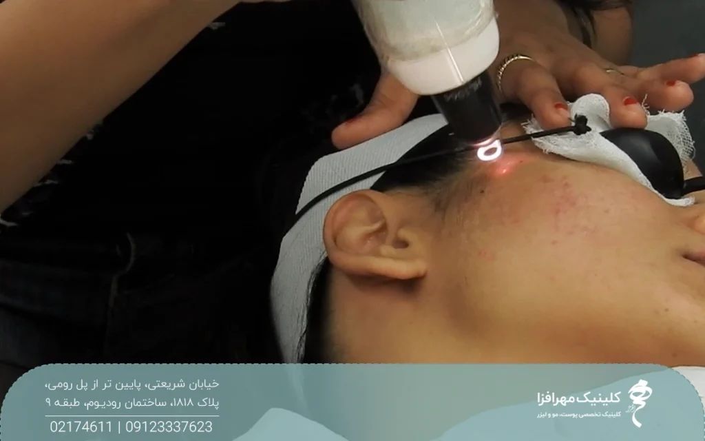 دختری که دراز کشیده و عینک محافظ دارد و دست اپراتوری که هندپیس لیزر کیوسوییچ را روی شقیقه او گرفته است