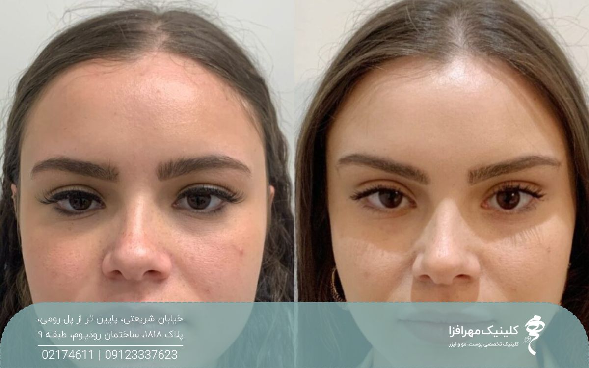 عکس قبل و بعد لیفت ابرو با نخ روی صورت دختر