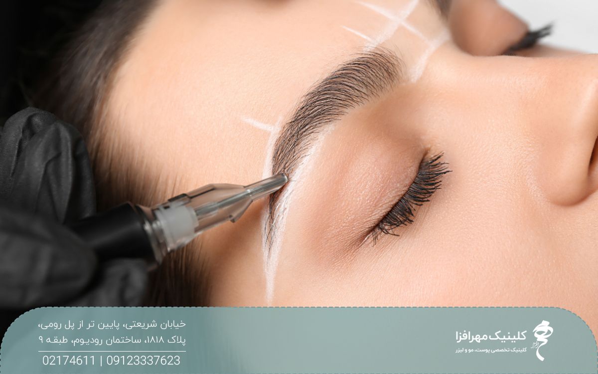 دختری که چشم او بسته است و ابروهای طیبعی و نازکی دارد و پزشک در ناحیه ابروی او با مداد سفید طراحی انجام داده است