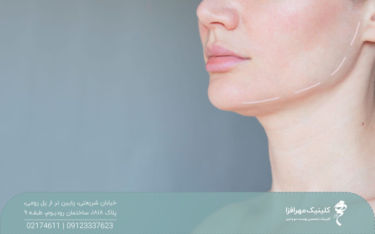 عکس از نیمه پایین صورت یک دختر که روی فک او یک خط چین سفید کشیده شده است