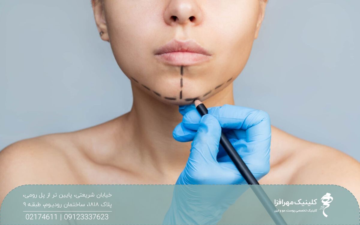 پایین صورت دختر که پزشک در حال کشیدن خط چین روی چانه و خط فک او است