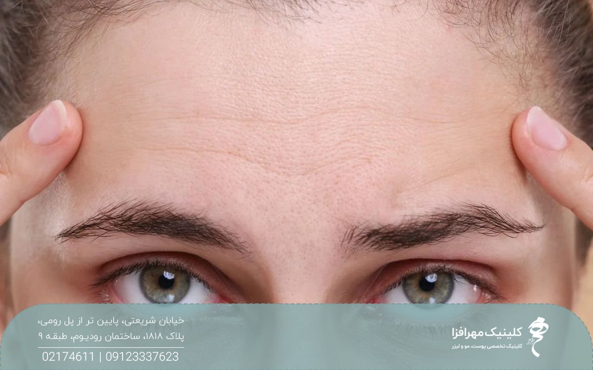 دختری که روی پوست پیشانی اش چروک های ریز دارد