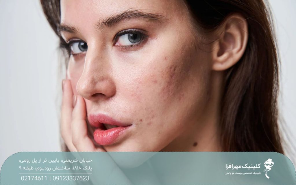 دختری که دستش را روی صورتش گذاشته است و پوست او جای جوش زیادی دارد