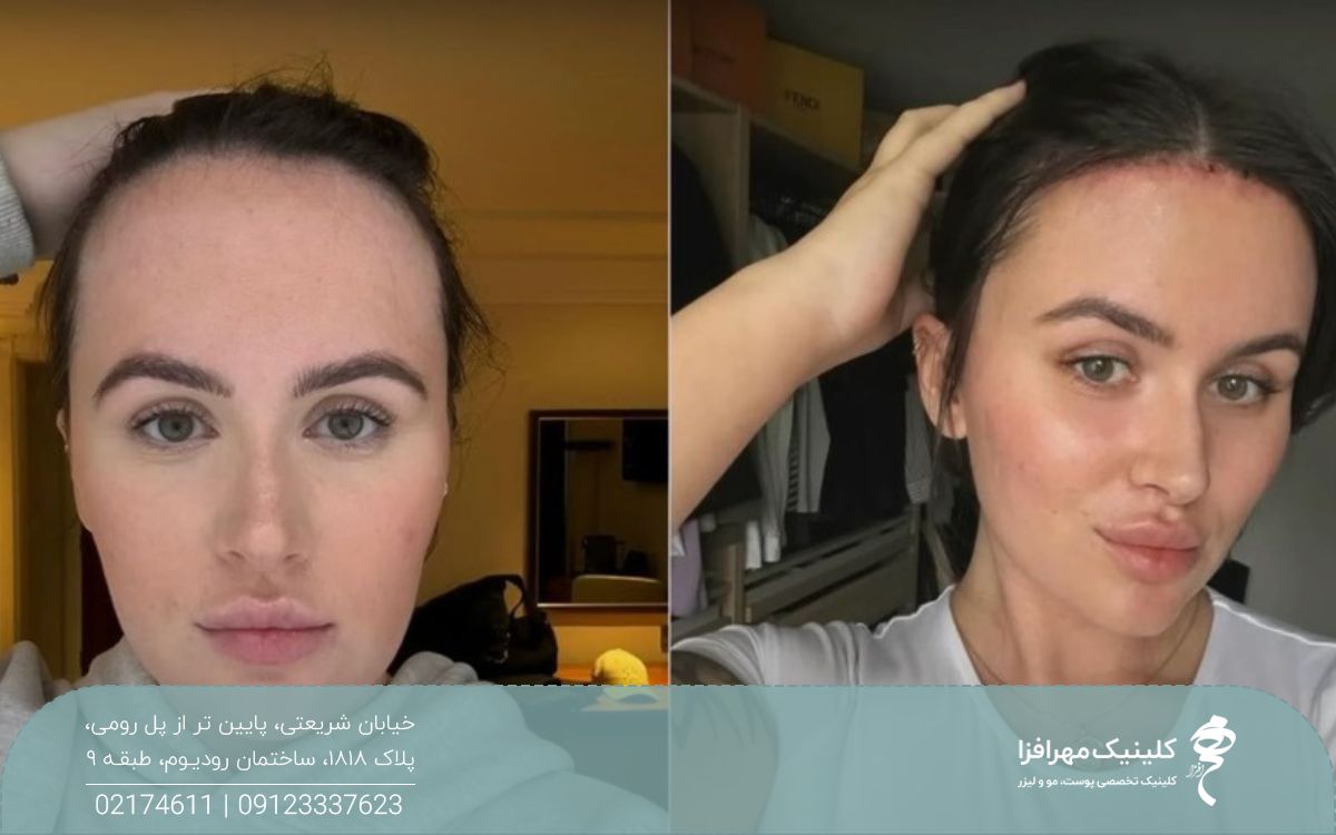 عکس قبل و بعد کاشت موی روی پیشانی دختری که پیشانی بلندی داشته است