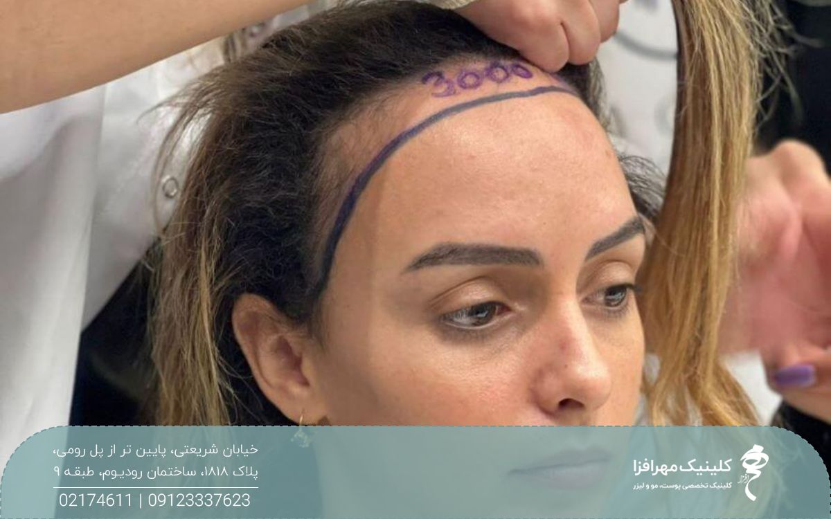 دختری که پیشانی بلندی دارد و پزشک برای اینکه روی پیشانی او کاشت مو انجام دهد با ماژیک ناحیه رویش را مشخص کرده و عدد ۳۰۰۰ را روی پیشانی او نوشته است