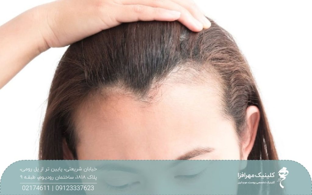 دختری که خط رویش او عقب نشینی کرده است و خط رویش او شکل M پیدا کرده است