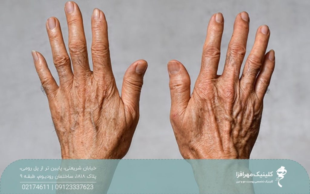 دستان فردی که چین و چروک بسیاری دارد و نیاز به جوانسازی دارد