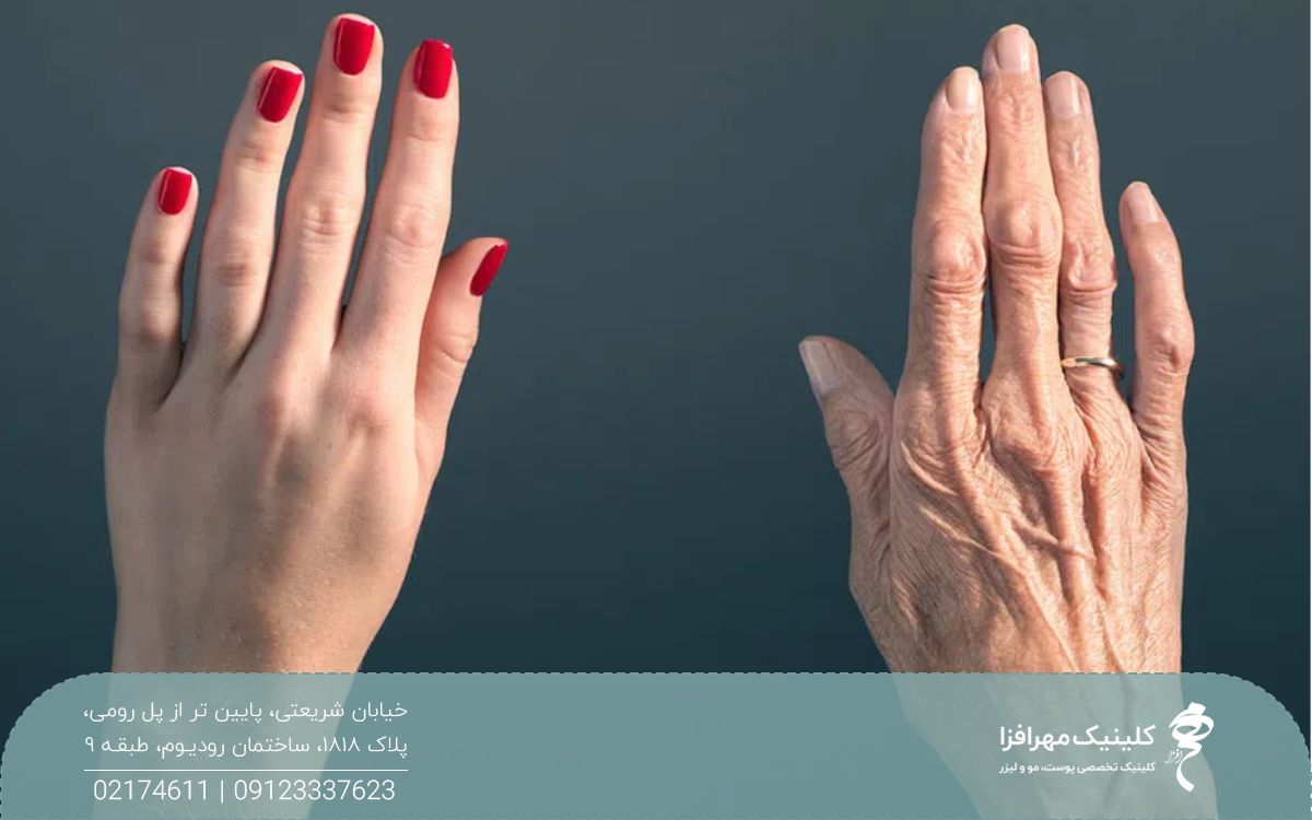 یک دست پیر و چروکیده در سمت راست و یک دست جوان که ناخن های آن لاک زده است در سمت چپ