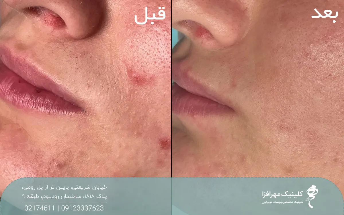 عکس قبل و بعد فردی که لیزر کیوسوییچ انجام داده است و جای جوش و آکنه او رفع شده است